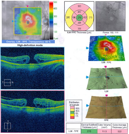 Buraco macular